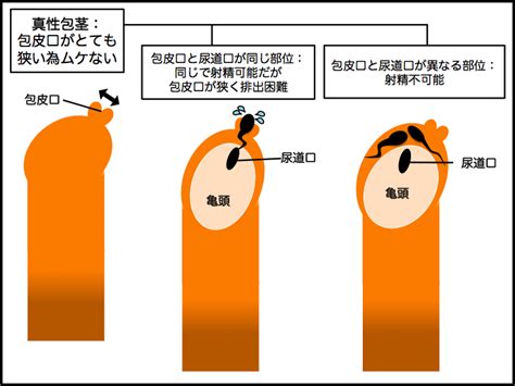 かせいほうけいとは|包茎とは？図で仮性・真性・嵌頓の見分け方をわかり。